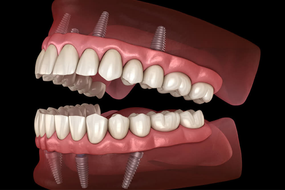 All-on-X implant - full arch fixed teeth