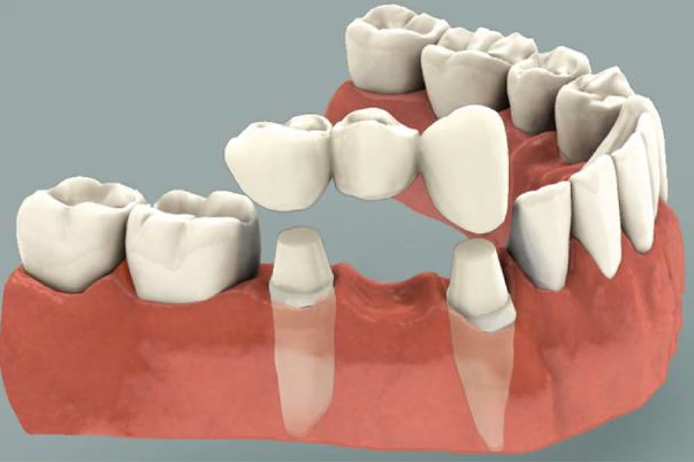 Dental bridge - fixed replacement using nearby teeth