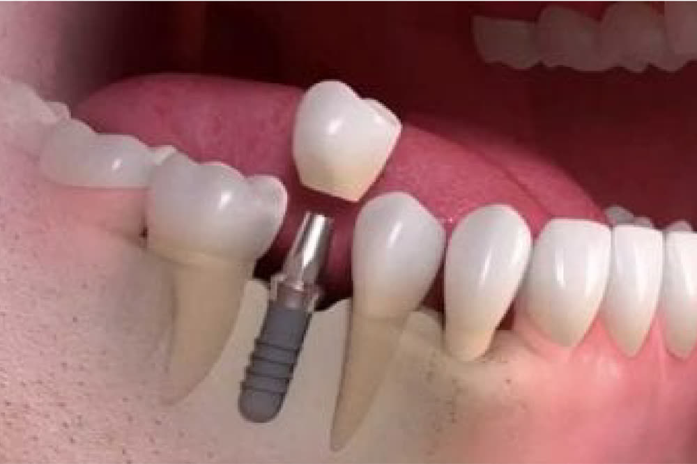 Dental implant - implant-supported replacement